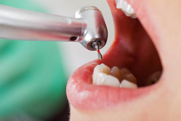 Best Emergency Tooth Extraction in Byron, GA
